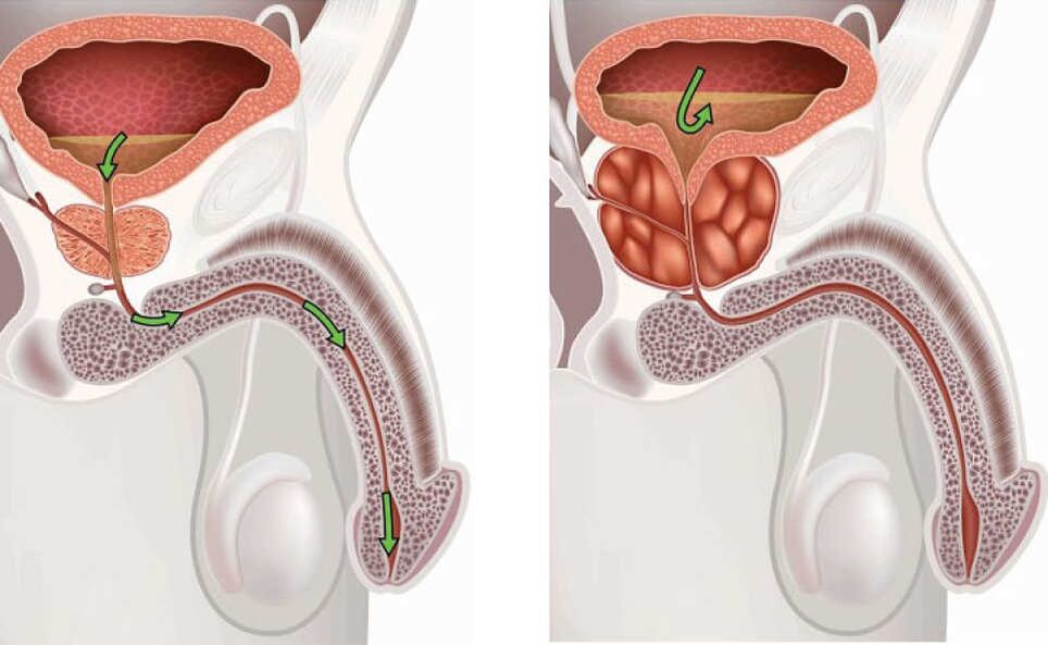 Inflamação da próstata