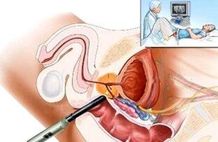 Maneiras de diagnosticar a prostatite