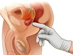 Massagem de próstata para tratamento de prostatite em homens