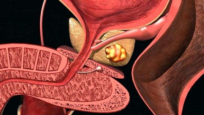 Depósitos de cálculos na próstata com prostatite calculosa