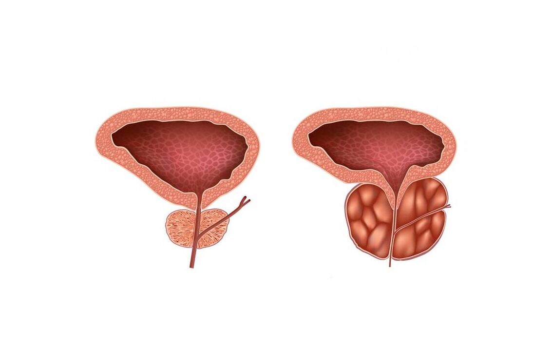 sintomas de prostatite em homens
