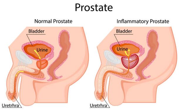 próstata saudável e inflamada