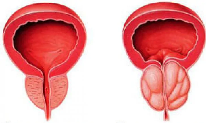Próstata normal (esquerda) e prostatite crônica inflamada (direita)