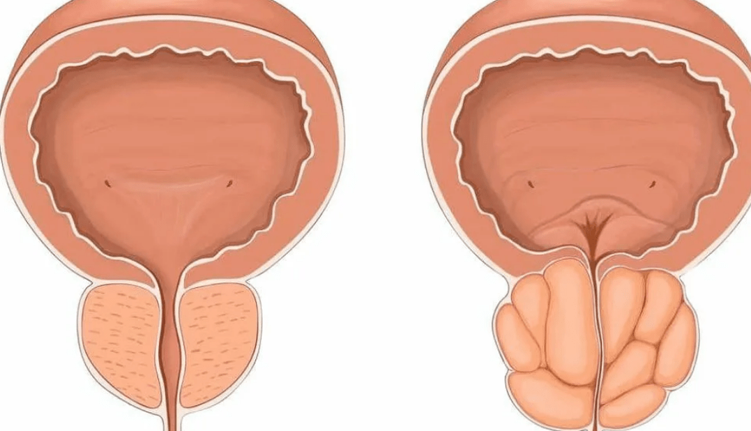 próstata saudável e doente