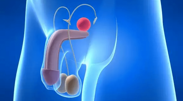 A prostatite é uma inflamação da próstata nos homens que requer tratamento complexo